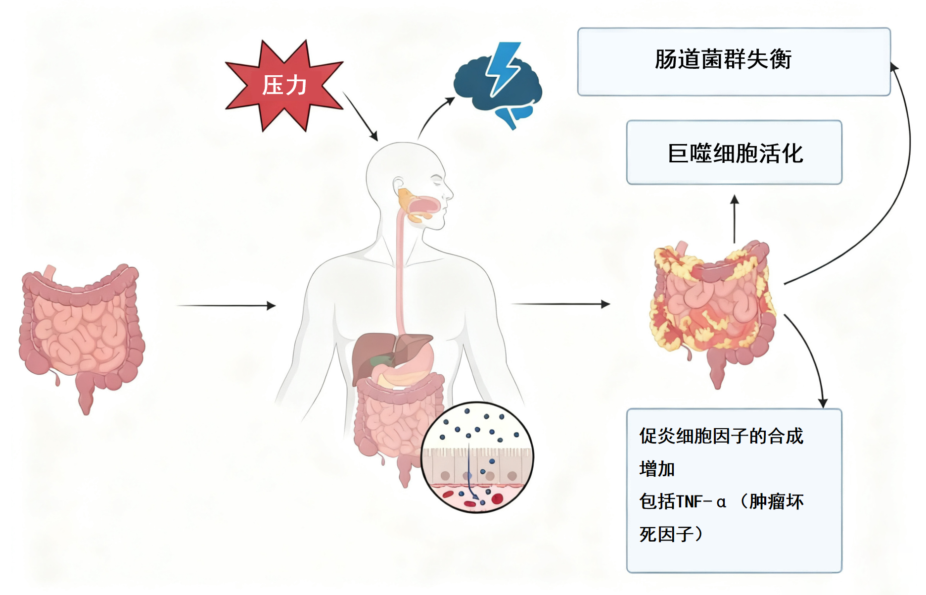 图片解读丨心理压力通过菌群失衡与免疫活化加剧炎症性肠病