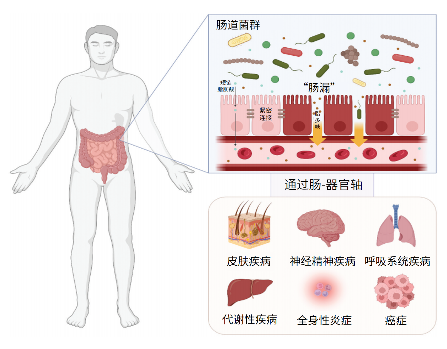 图片解读丨肠漏与全身疾病