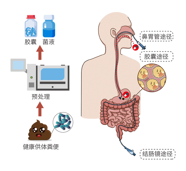 解答:
什么是精准菌群移植?
指将健康供体的肠道菌群通过智能肠菌处理系统制成混悬液或胶囊,采用供-受体配型技术选择最优的供体菌群,移植到受体肠道内,重建正常功能的肠道菌群以实现肠道内及肠道外疾病的干预。