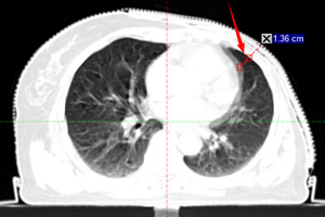乳腺癌DIBH治疗之呼吸“随心”,不伤心