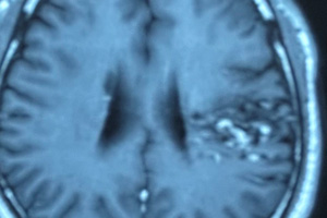 头部治疗利器---伽玛刀