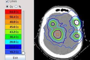 计划不烦“脑”,HyperArc“超弧刀”临床计划及治疗实施经验分享