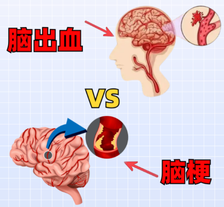 脑出血和脑梗死到底哪个更严重？90%的人第一反应都错了！