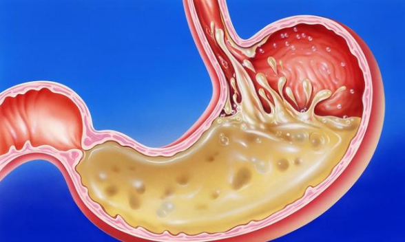 关注贲门健康，守护消化系统！