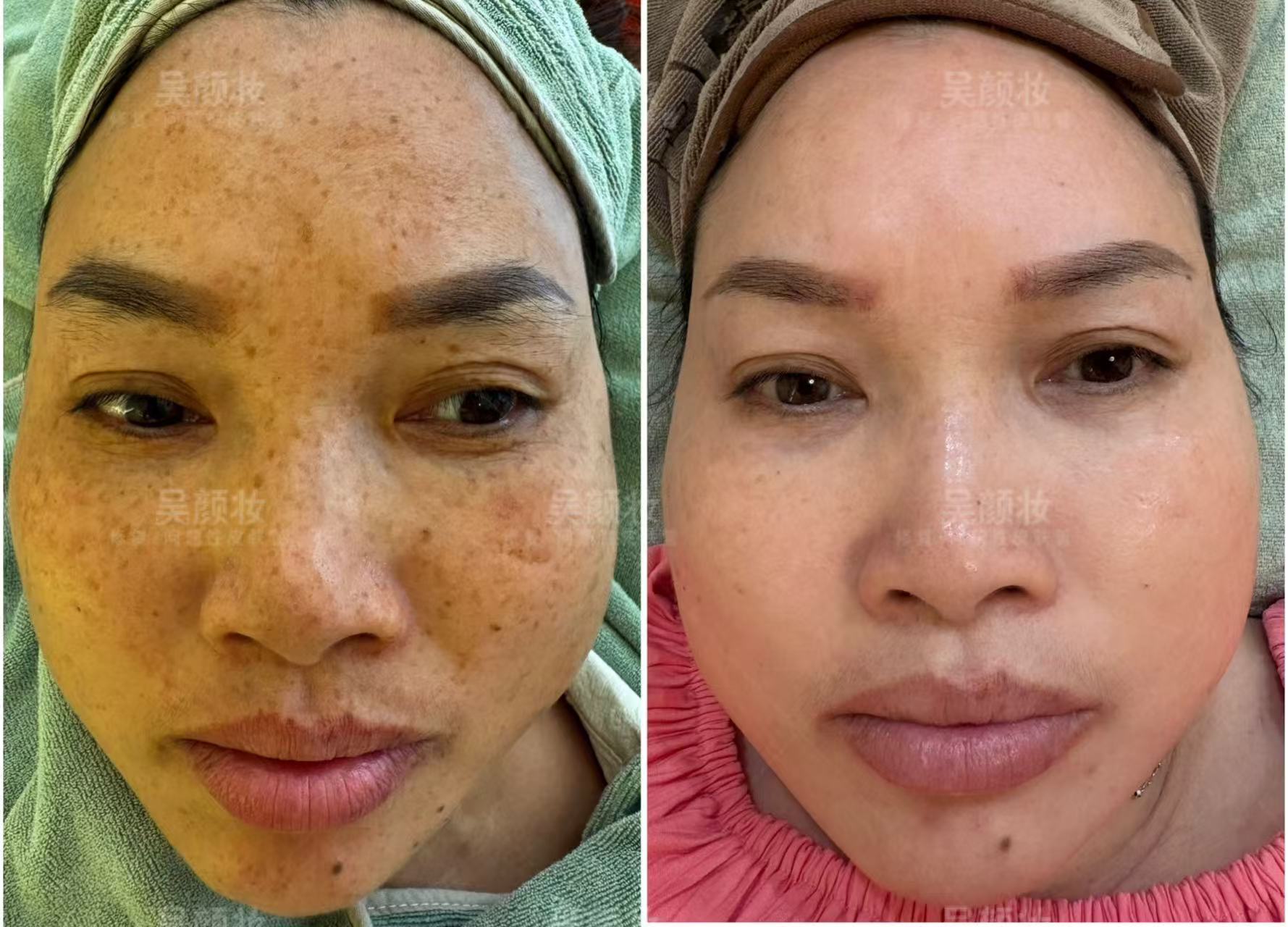 英姐的祛斑蛻變之旅：遇見(jiàn)吳顏妝，重拾自信與光彩