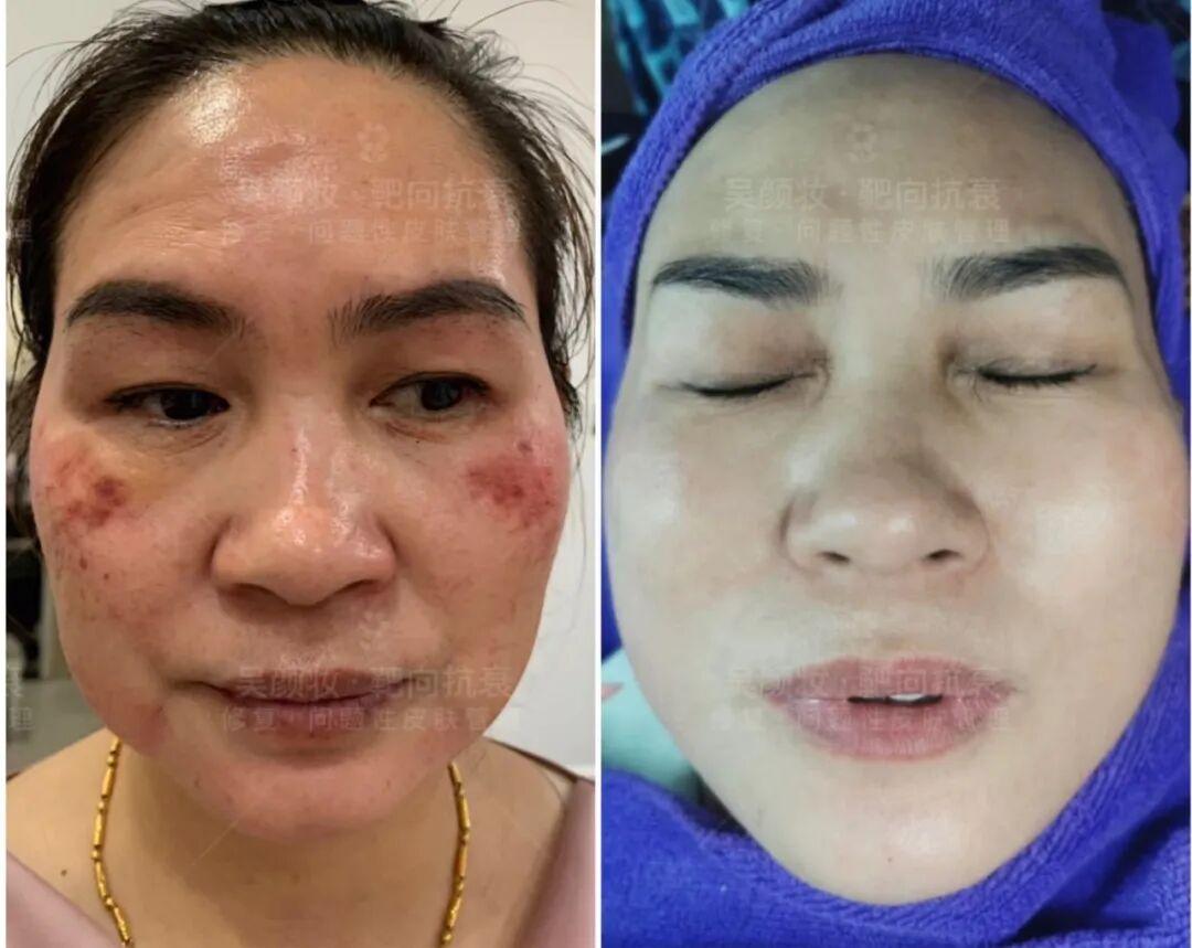 吳顏妝夏季代言人故事｜被棄的爛臉重生：小妖老師，是她黑暗里的光