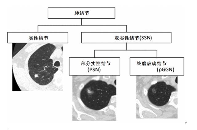 肺部结节的快速诊断和健康管理策略