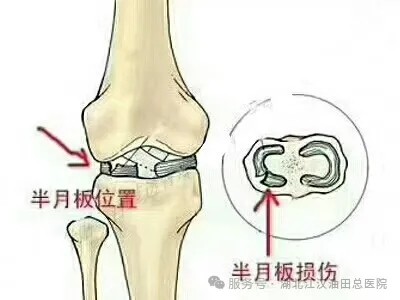 微创关节镜技术让“破碎半月板”重获新生