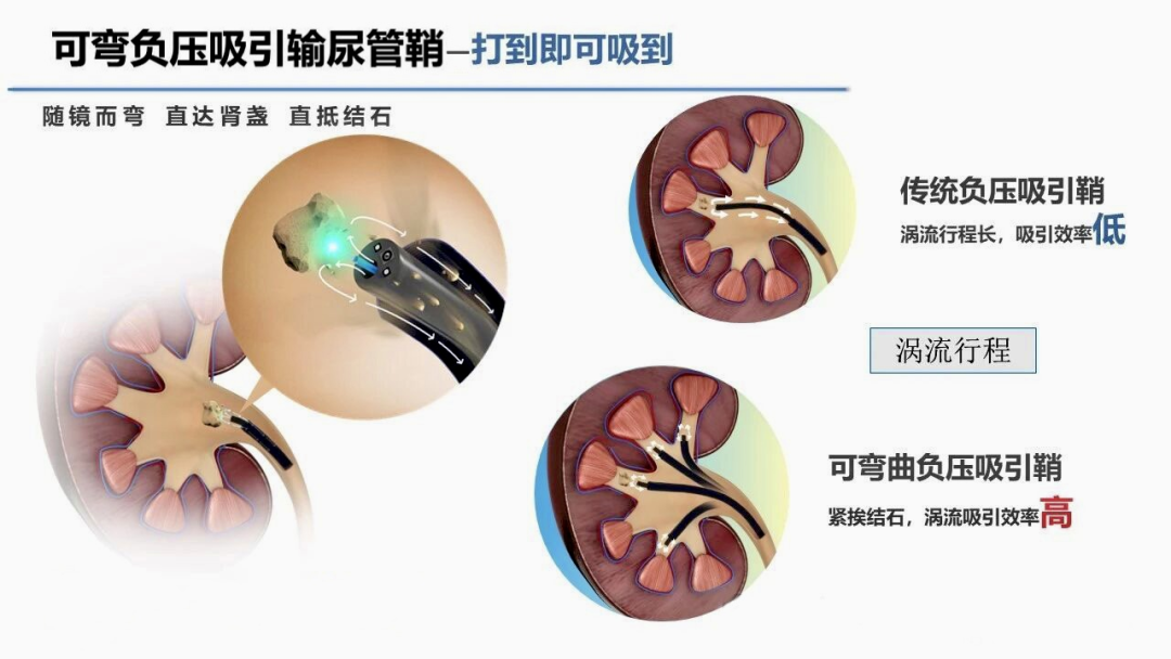 肾结石的新疗法：负压吸引鞘输尿管软镜碎石术