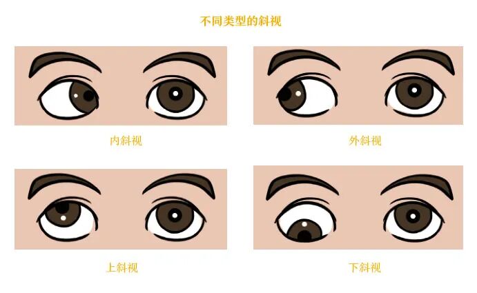 孩子眼睛 “跑偏”？早发现、早干预，别让斜视留终身遗憾