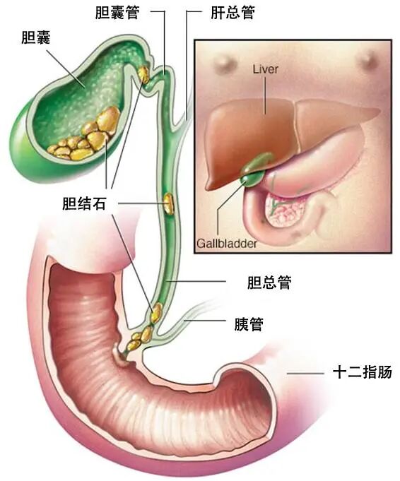 小石头大麻烦|胆囊结石知识点，你学对了吗？