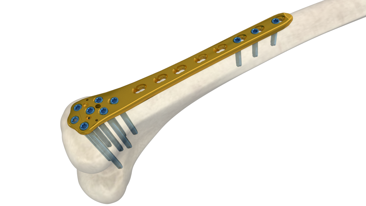 5.0mm Distal Lateral Condyle Femoral LCP