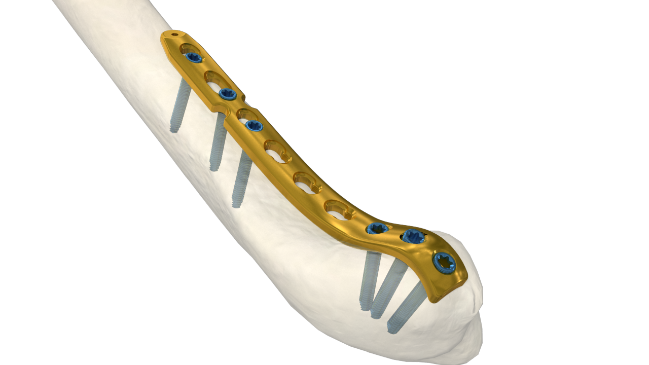 3.5mm Distal Medial Humeral LCP