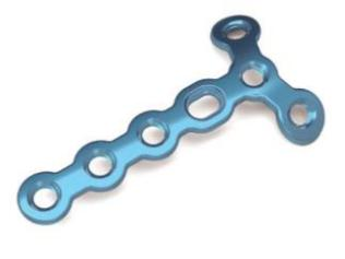 1.5mm Locking Y Plate