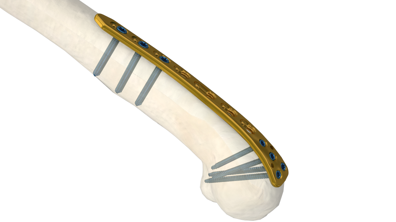 Distal Lateral Humeral LCP, 2.7/3.5mm