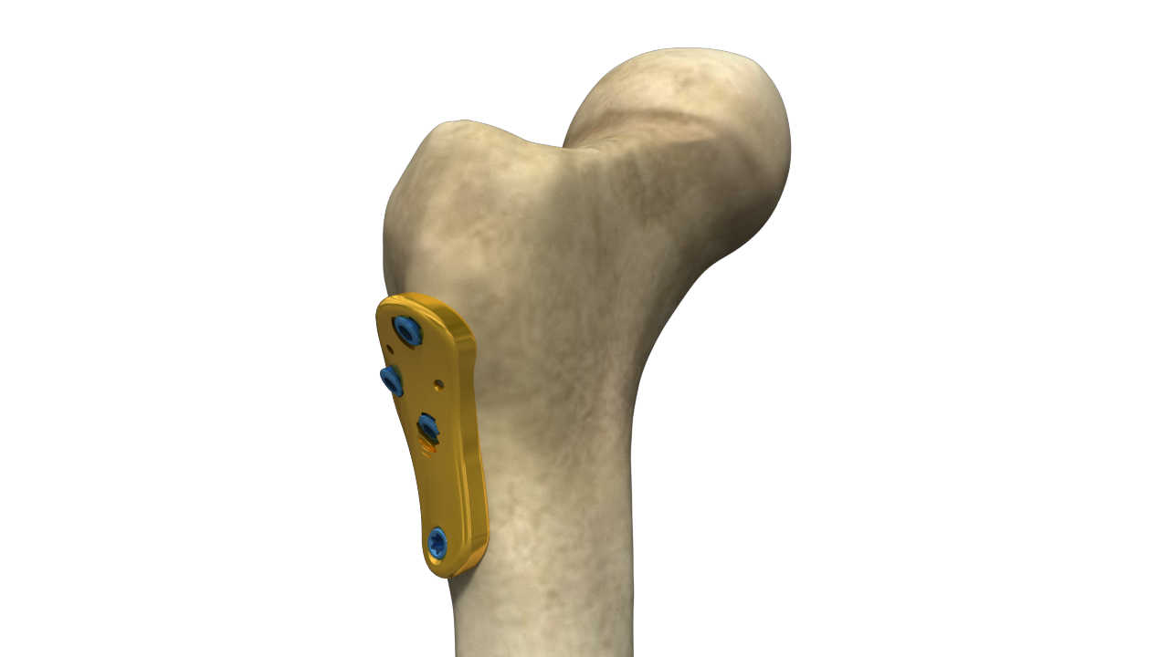 Proximal Femoral LCP, 5.0/7.3mm