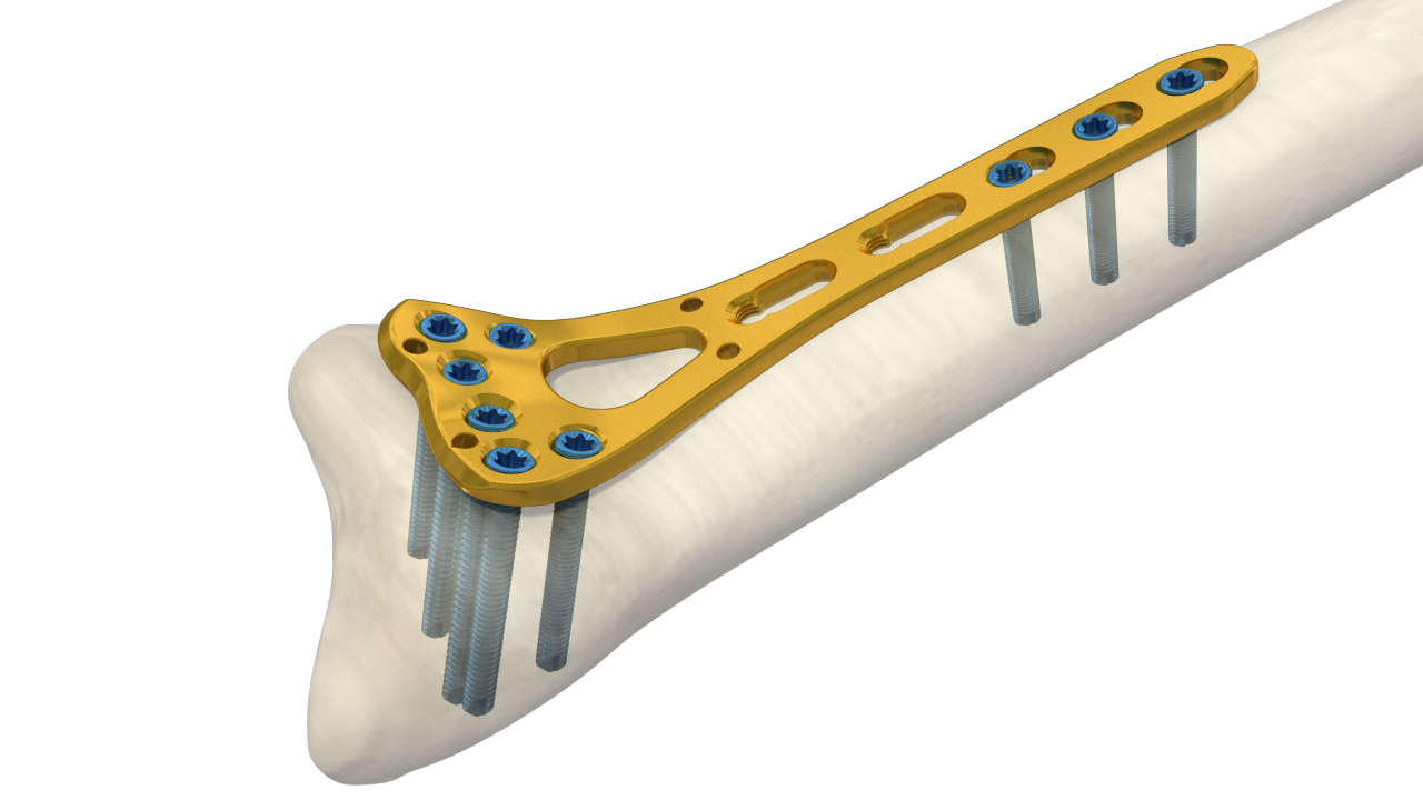 Distal Radius Volar LCP - I