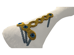 1.5T head with 3 holes