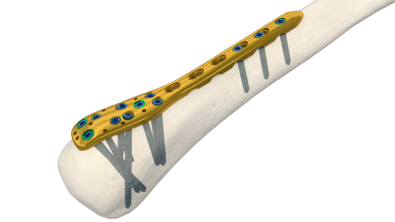 3.5mm Proximal Humeral LCP